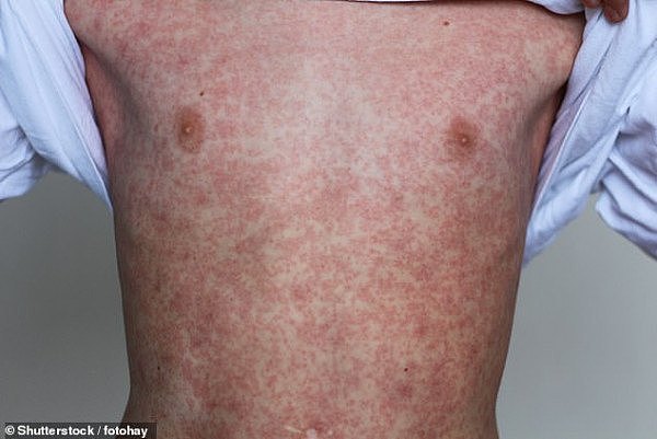 15696686-7226535-Another_case_of_measles_has_been_reported_in_Brisbane_after_a_ch-a-5_1562631401105.jpg,0