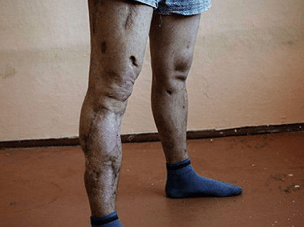 恐怖慎点！“丧尸来袭”：危险毒品蔓延澳洲，吸食者皮肤感染，手脚溃烂（组图） - 3