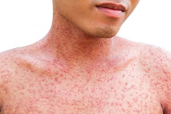 allergy-asian-background-body-care-closeup-d-20190425175036-44492400.jpg,0