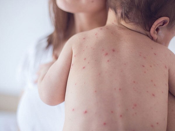 HOW-Online-Measles-Outbreak.jpg,0