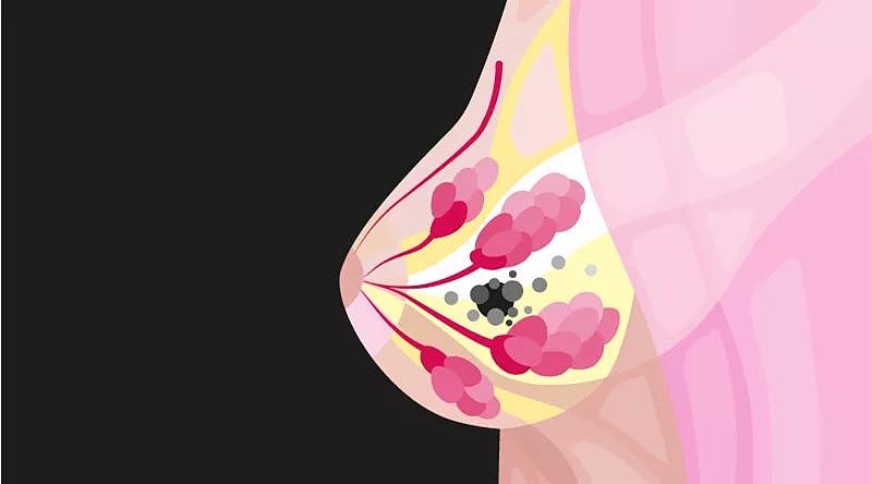 【健康】容易引发乳腺癌的 7 种情况，每位女性都要注意！（组图） - 1