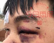 气愤！中国孩子在澳洲首都被“钉”在墙上打！眉骨开裂，满脸是血！一只眼睛短暂失明！目前警方与当地教育局已介入！华人需发声！