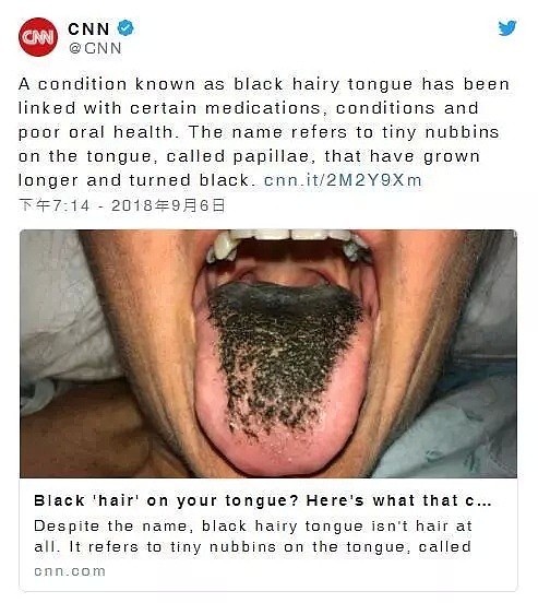 美国女子滥用抗生素，舌头长出大量黑毛！滥用抗生素下场太可怕（组图） - 1