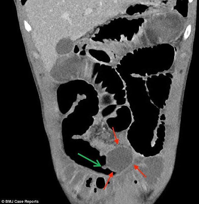 Original scans (CT scan pictured) did not clearly reveal what was blocking the intestine because the balloon (marked by the arrows) was not as dense as a solid object would be so it was harder to spot Â¿ some healthy parts of the man's body show as the same shade of grey