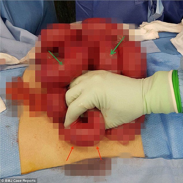 Surgeons pulled the man's small intestine outside of his body to examine it, and they felt a small, soft lump which could be moved around Â¿ only when they cut open the organ did they realise it was a balloon