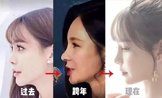 取出鼻子里的假体，沈梦辰又美回来了，可当初为什么想不开？（组图） - 4