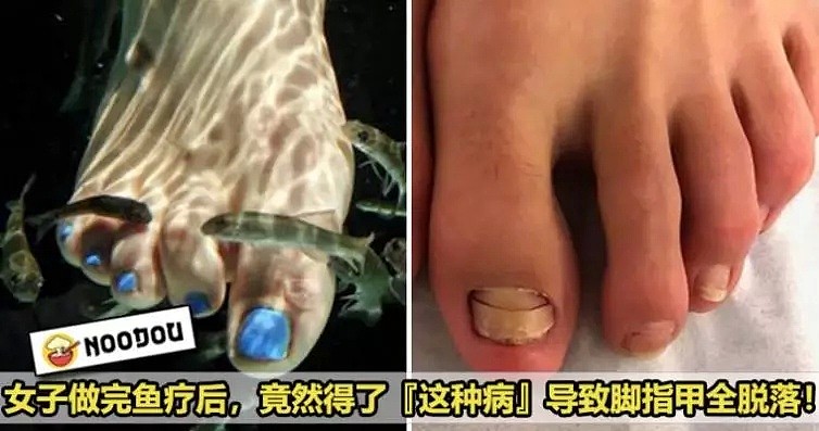 中国人超喜欢的这项按摩，却导致澳洲女子五个脚趾被截肢！（组图） - 28