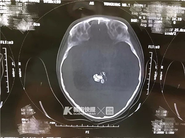 惊呆！5岁男孩摔一跤头痛呕吐，医生竟从他脑袋里取出9颗牙齿！（组图） - 2