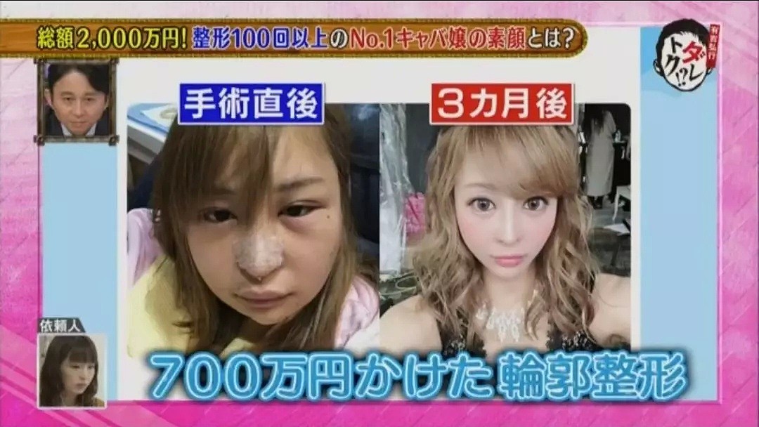被喊“大猩猩”，从小就受欺负的日本丑女整形100次之后，终于变成了漂亮的陪酒女！（组图） - 19