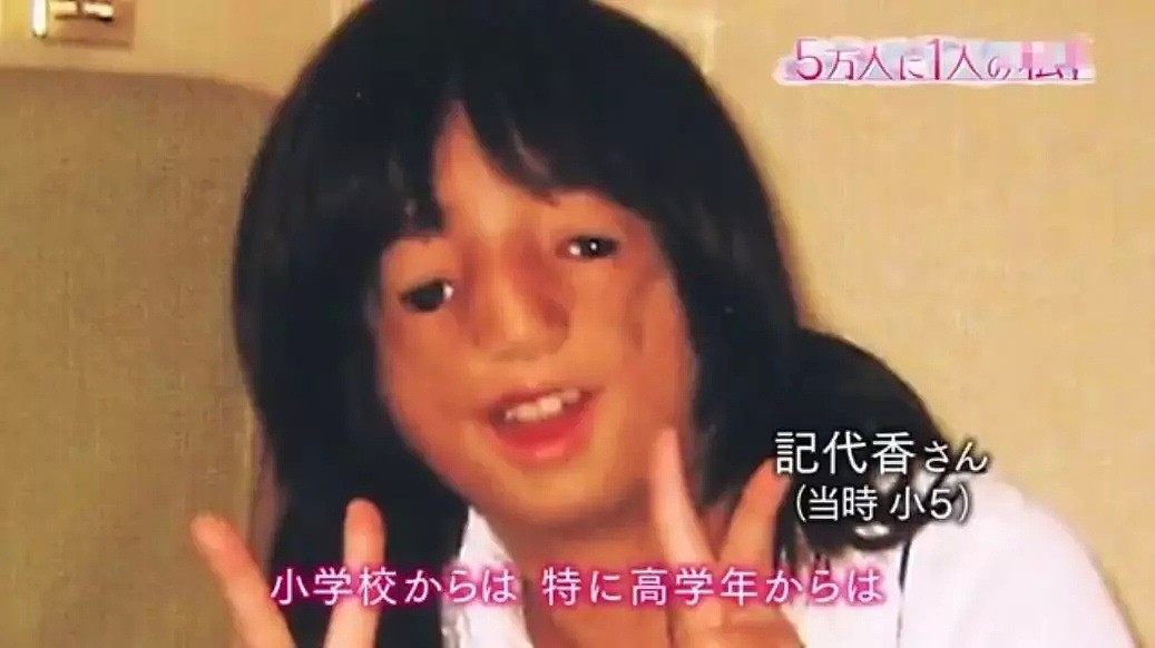 五万人一遇的无脸症，日本少女从出生就被嘲笑，她却说：“妈妈，谢谢你生下我”（组图） - 11