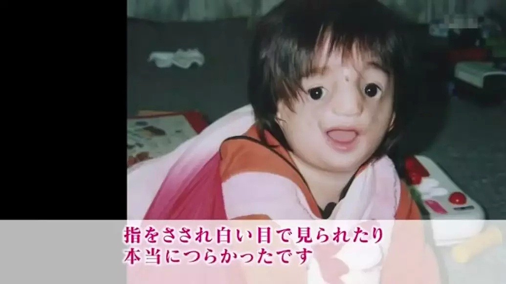 五万人一遇的无脸症，日本少女从出生就被嘲笑，她却说：“妈妈，谢谢你生下我”（组图） - 18