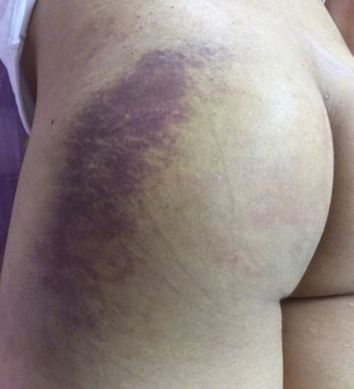 虐殴50次！16岁男团遭工作人员暴打致全身发紫 受伤照触目惊心！！（组图） - 13