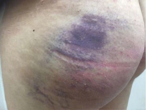 虐殴50次！16岁男团遭工作人员暴打致全身发紫 受伤照触目惊心！！（组图） - 17