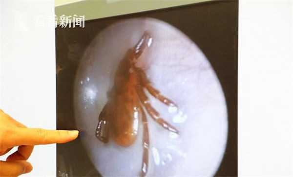 恐怖！耳朵痒痒 竟夹出一条10厘米长活蜈蚣！（组图） - 2