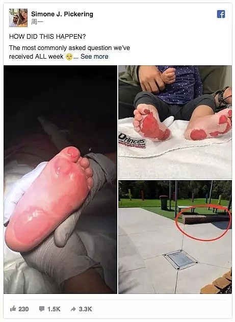 痛心！昆州女婴赤脚走路被严重烫伤！高温天家长千万当心（组图） - 3