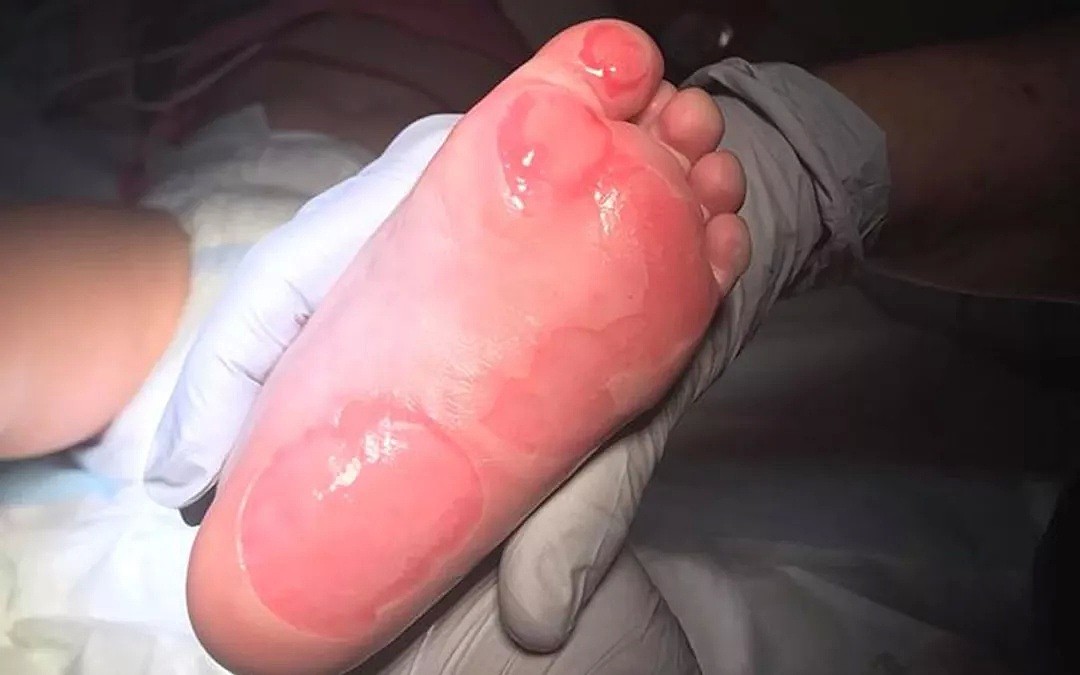 痛心！澳女婴赤脚走路被严重烫伤！罪魁祸首竟是大街上随处可见的它！（组图） - 8