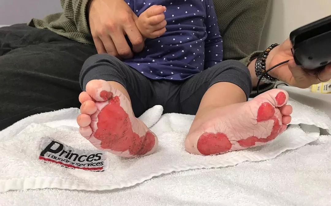 痛心！澳女婴赤脚走路被严重烫伤！罪魁祸首竟是大街上随处可见的它！（组图） - 9
