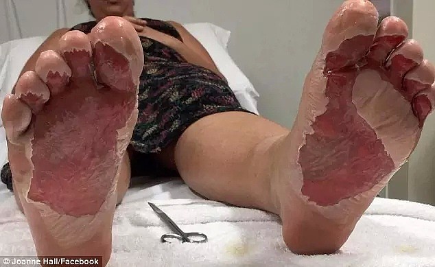 痛心！澳女婴赤脚走路被严重烫伤！罪魁祸首竟是大街上随处可见的它！（组图） - 12