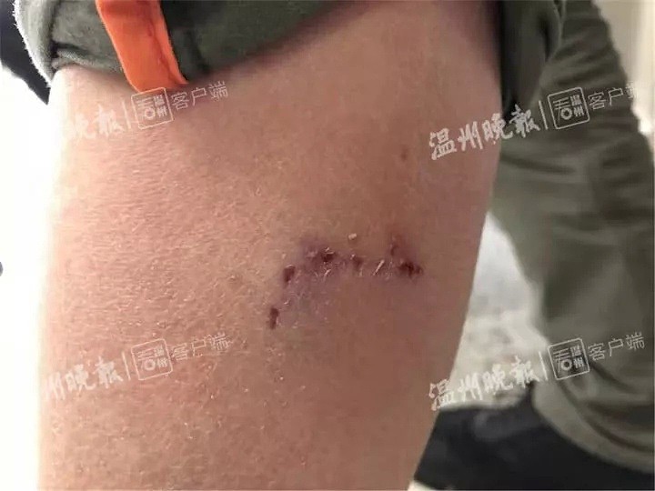 视频曝光！温州流浪狗咬伤73人，最小仅2岁…警方仍在搜捕（视频/组图） - 3