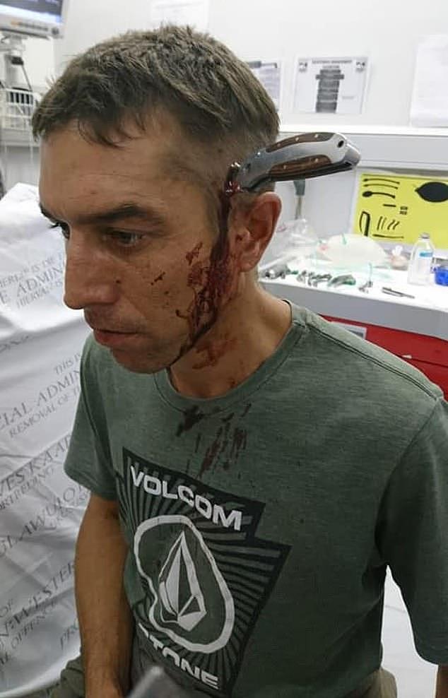 南非男子上班路上遇袭头部被插长刀，淡定骑车去医院就诊惊呆医生