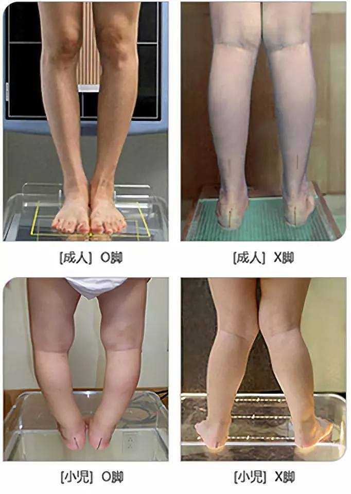 为何日本女生“罗圈腿”居多？揭开腿的秘密（组图） - 10