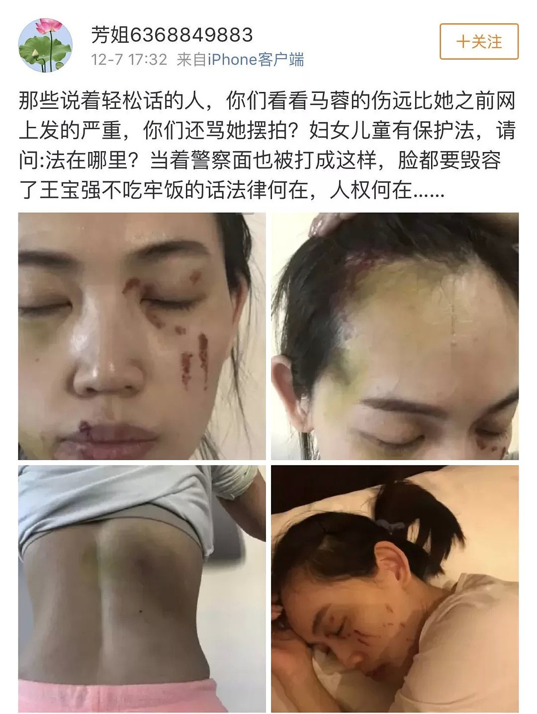 马蓉诊断书曝光伤情严重恐毁容，王宝强还在警察局，被指婚内出轨有私生子！（组图） - 2