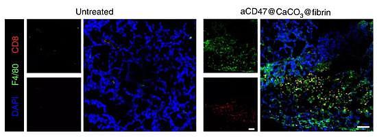 经过免疫凝胶治疗（右）的小鼠CD8+ T细胞（红）和巨噬细胞（绿）增多