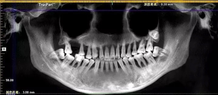 28岁姑娘一排牙都被医生拔光！这个习惯害苦她（组图） - 2