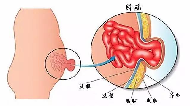 无知！1个月大婴儿肚脐外鼓，父亲竟一刀划开放气……