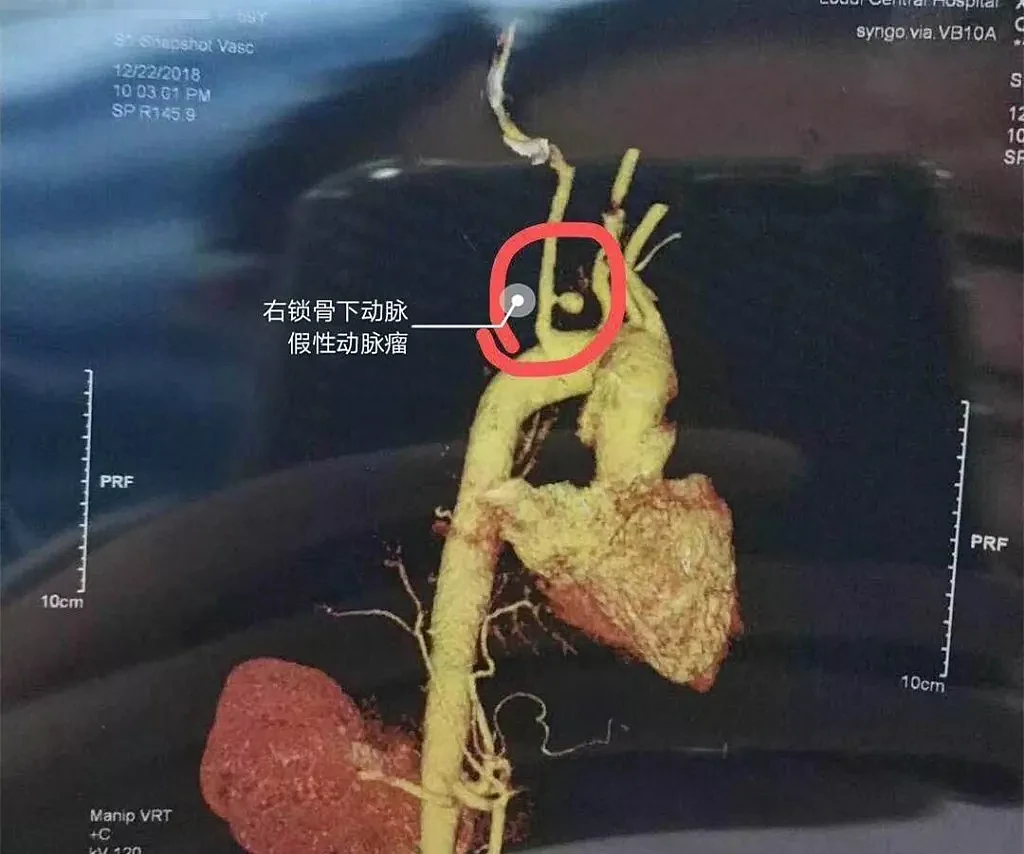 59岁大妈2次呕掉全身的血险丧命 背后原因竟是它