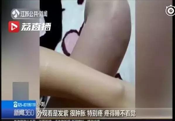 21岁女大学生连续5天不下床，一看双腿吓坏了！医生：再来晚点，性命不保！