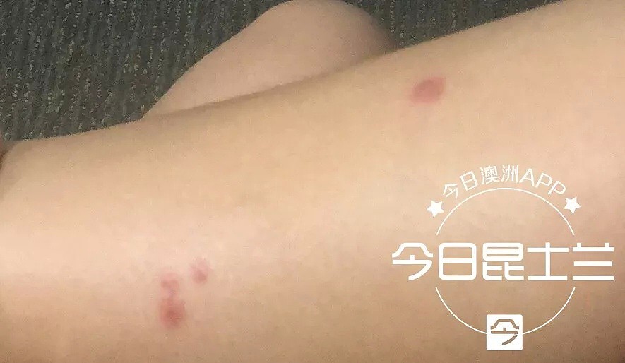 UQ中国女留学生被“不明毒虫”咬伤，伤口发红，寝食难安！在澳洲，不少人曾因毒虫瘫痪，生活无法自理（组图） - 1