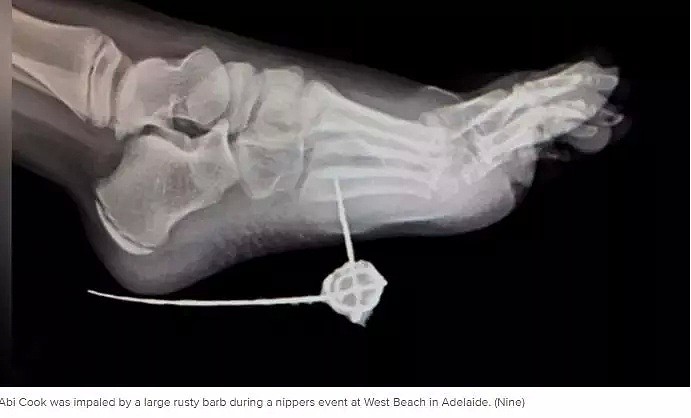 注意！澳热门沙滩惊现多个生锈大铁钩！8岁女童脚心被扎烂！已有4人受伤！ - 9