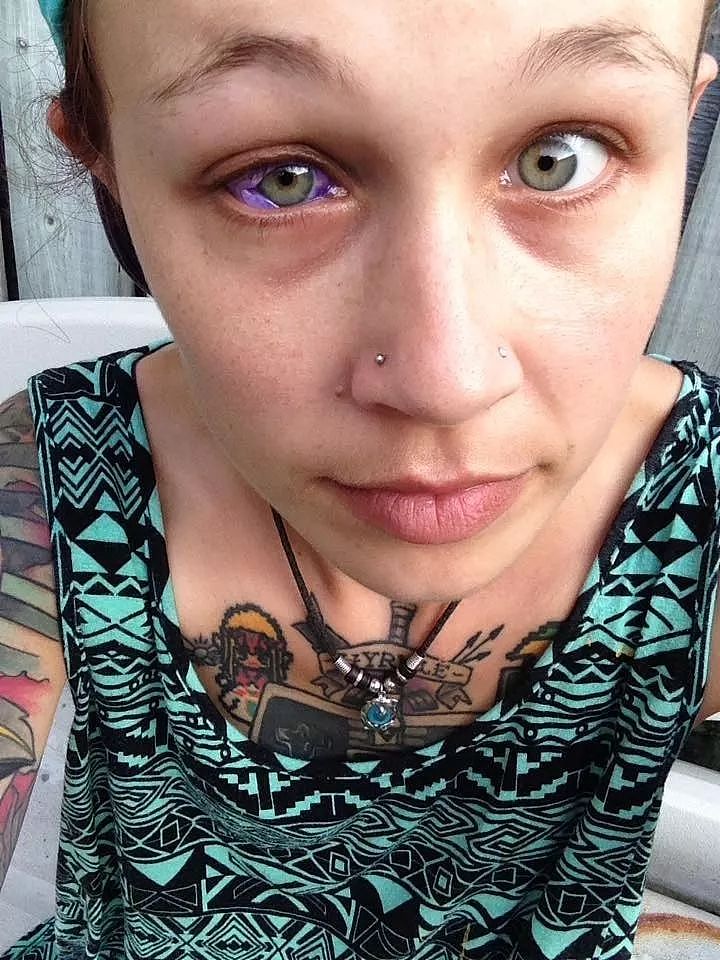 不作死就不会死：加拿大女子在眼球上纹身，现在或将永久失明！（组图） - 3