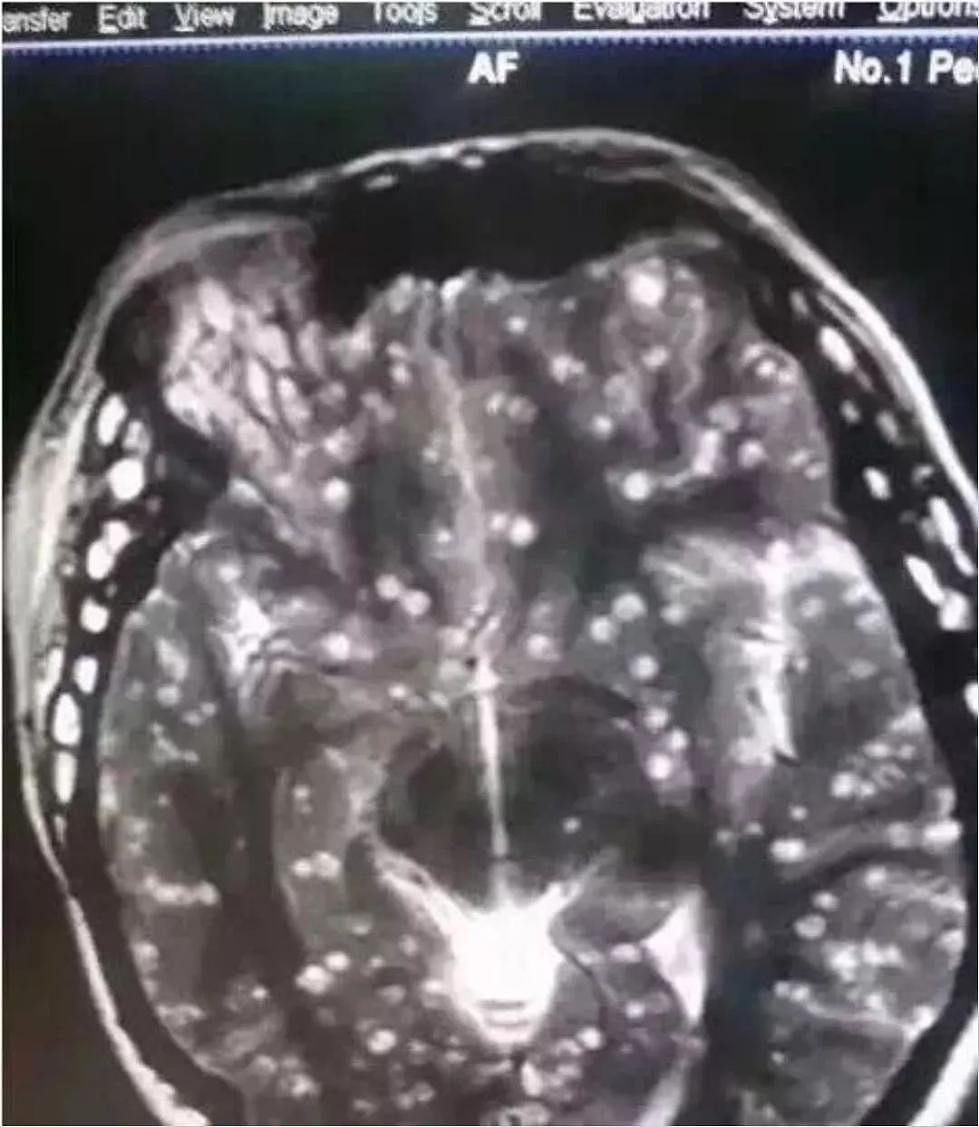 她多年头痛，竟是因为有东西在脑袋里“挖隧道”…（组图） - 1