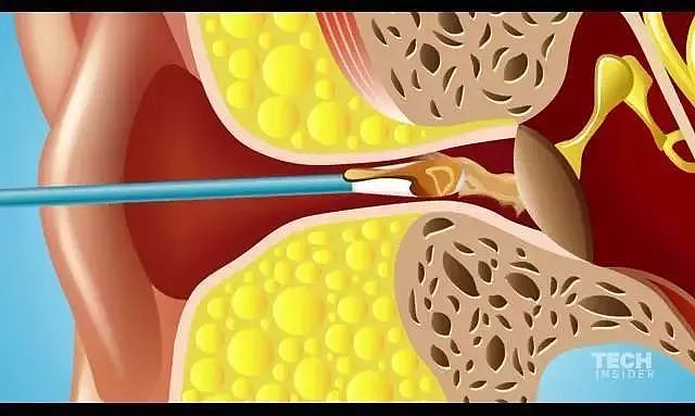 可怕！千万别再用棉签掏耳朵！澳洲妹子差点丧命，还有人癫痫、患癌（组图） - 16