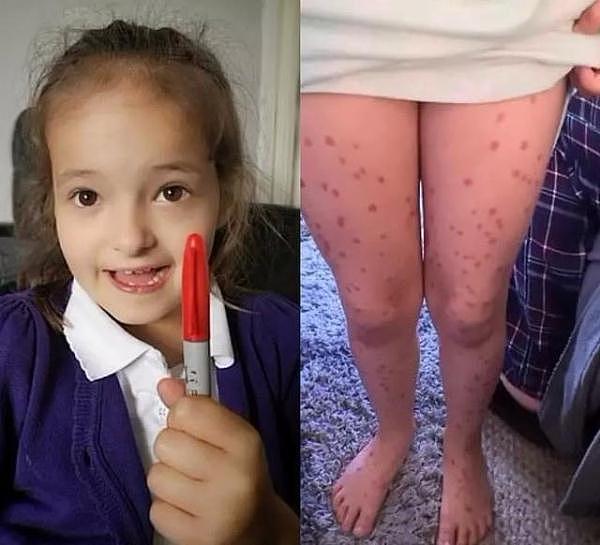 英国6岁小女孩为逃避考试全身画满“水痘”，没想到怎么也擦不掉
