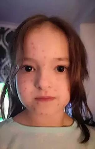 英国6岁小女孩为逃避考试全身画满“水痘”，没想到怎么也擦不掉