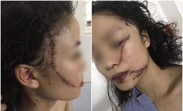 惨！18岁女子被闺蜜持刀割伤脸部，缝60针毁容破相