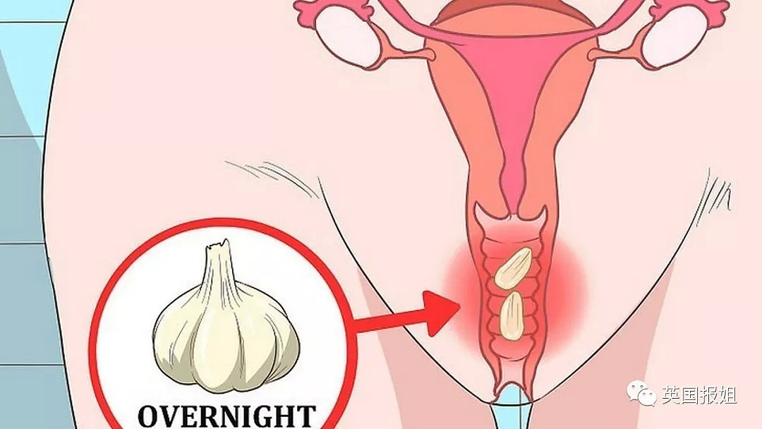 那些病急乱投医的女孩，把大蒜塞进自己下体……（组图） - 7