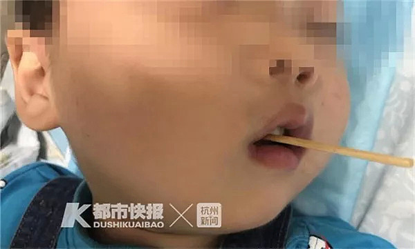 触目惊心！3岁男孩被连夜送来杭州，竹签从嘴巴直插脑干！（组图） - 1