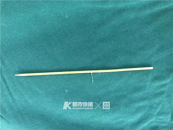 触目惊心！3岁男孩被连夜送来杭州，竹签从嘴巴直插脑干！（组图） - 4