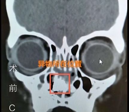 孩子发出阵阵臭味：一看这都坏死了！一生都受影响（组图） - 1