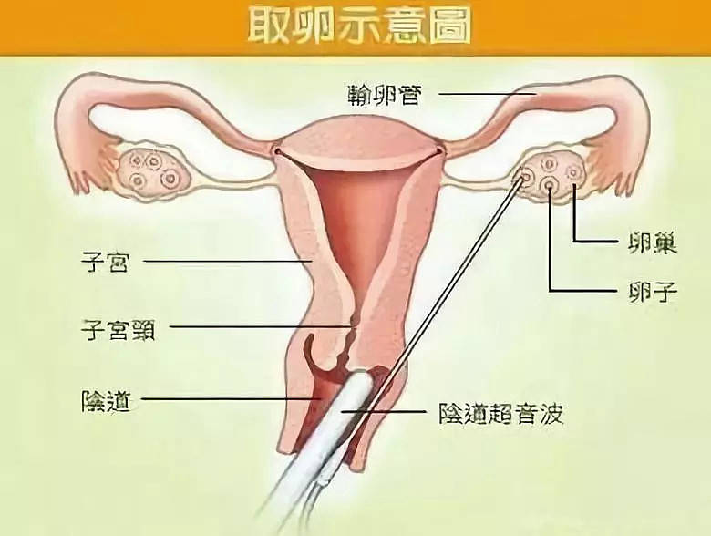 “不打麻药，穿刺下身，一次5万”：多少爸妈捧在手心的女孩，正在贱卖自己（组图） - 10