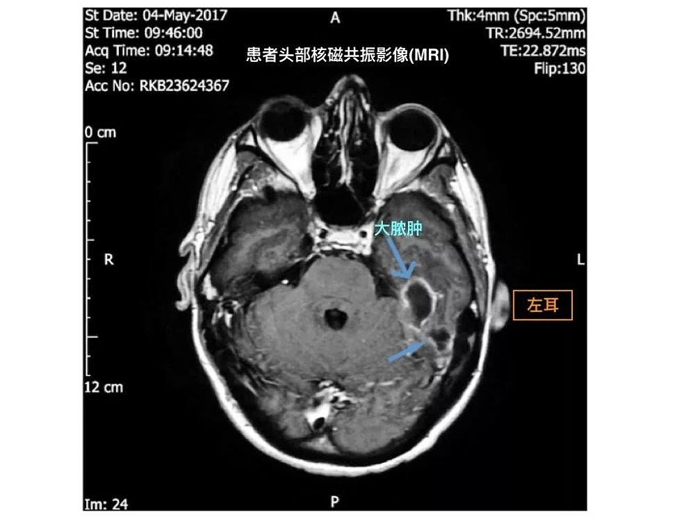 患者的MRI图丨来源：论文1