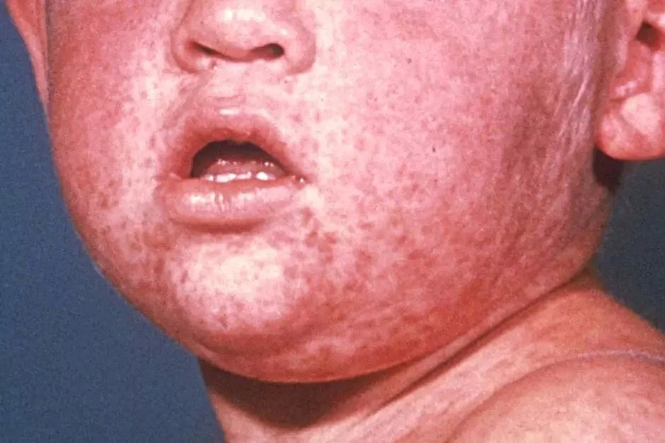 维州爆发一年多来最大规模麻疹！去过这些地区的人千万要注意！ - 3