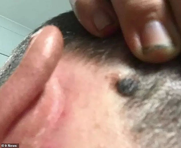 耳朵后面长了个黑点，澳洲医生说只是“痣“，数月后发现已是癌症晚期…… - 4