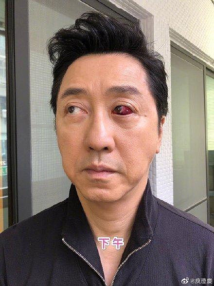 57岁庾澄庆近照眼睛受伤好严重，左眼充血太吓人