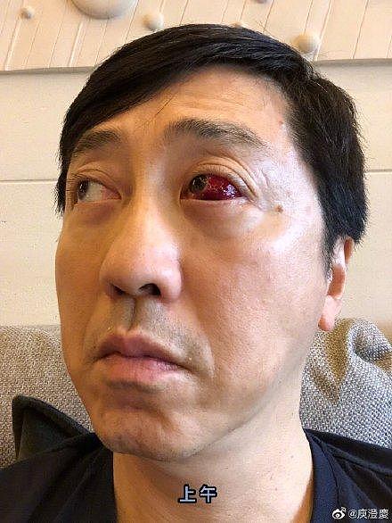57岁庾澄庆近照眼睛受伤好严重，左眼充血太吓人