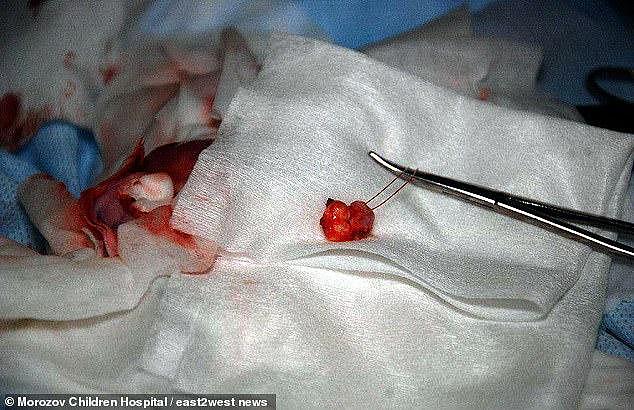 俄罗斯13岁男孩睾丸中存在不明肿块，手术取出竟是一颗牙齿